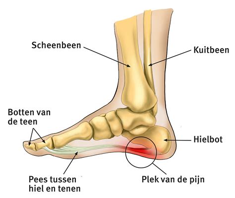 pijnlijke hielspoor